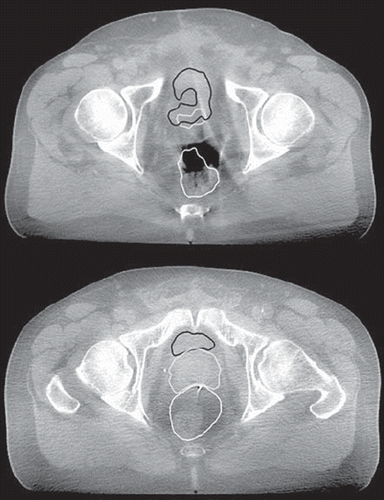 Figure 3. The low image quality illustrated in two axial slices of two of the CBCT scans for two different patients (patient 3 - upper figure, patient 2 - lower figure) with the propagated contours from the DIR (prostate grey; rectum white and bladder black) overlaid. In addition the inabilities of the investigated DIR algorithm to handle bowel gas (upper figure) and the artefacts from the fiducial markers (lower figure) are demonstrated.