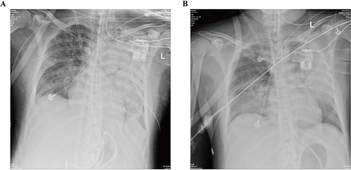 Figure 4 Chest X-ray scans on the abnormality in lungs during the VV-ECMO support hospitalization. (A) Chest X-ray on the first day of VV-ECMO showed exudation, consolidation, and bilateral pleural effusion in both lungs, especially in the left lung. (B) Chest X-ray on the third day of VV-ECMO showed the exudation, consolidation, and bilateral pleural effusion were relieving than before.