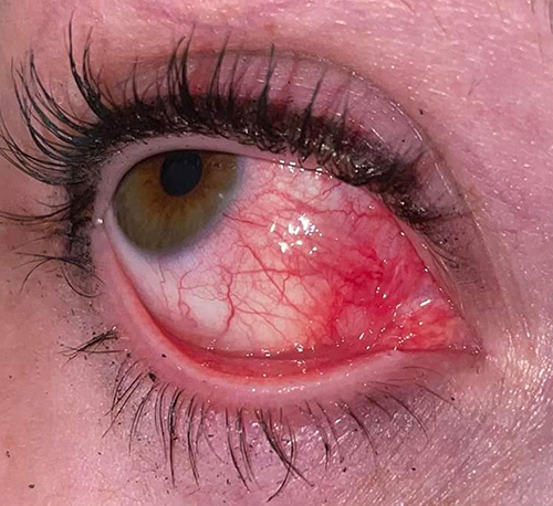 Figure 1 Episcleritis of the right eye. Nasal view of the right eye showing 2+ conjunctival injection.