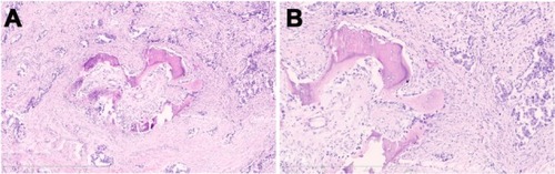 Figure 2 (A) Tumor showing the moderately differentiated adenocarcinoma growing with a born formation. Hematoxylin and eosin staining, original magnification ×50. Scale bar 1 mm. (B) Mature bony trabeculae in the abundant fibroblastic stroma were surrounded by osteoblasts. Hematoxylin and eosin staining, original magnification ×100. Scale bar 600 μm.