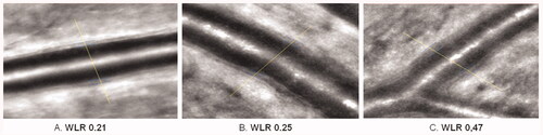 Figure 5. Comparison of retinal arteriolar WLR measured in 3 male patients with normal BMI and similar physical activity (over 300 min/week) by adaptive optics rtx1. (A) Left eye, retina temporal superior from optic nerve of 60 years old man with optimal blood pressure without arterial hypertension therapy. (B) Right eye, retina temporal superior from optic nerve of 61 years old man with measured normal blood pressure with consequently arterial hypertension therapy. (C) Left eye, retina temporal superior from optic nerve of 60 years old man with arterial hypertension stage 2 without arterial hypertension therapy. All measurements and analysis were done in the same conditions (5 min after rest in sitting position in dark room with 23C room temperature without mydriasis; by J.M.H.).