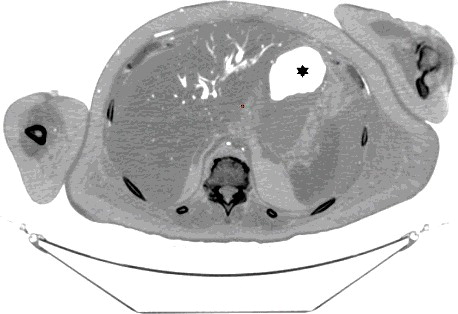 Figure 7. Axial CT (inverse grey scale): The hepatic parenchyma shows mostly intravascular air filling the intrahepatic vasculature and possibly minute dots of parenchymal air. The area marked with a star represents normal gastric air.