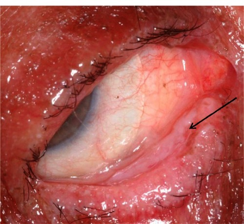 Figure 3 Right lower fornix of the patient five weeks after disease onset. Evident is a contracted tarsal conjunctival membrane (arrow) resulting in cicatricial entropion, trichiasis, and corneal epithelial breakdown.