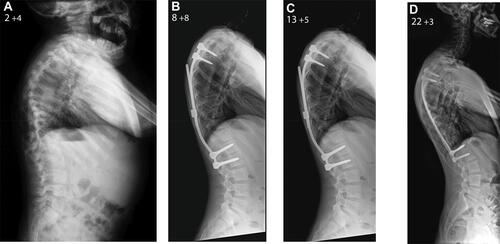 Figure 2 Lateral x-rays of the spine in patient 1 before TGRs insertion (A) and during the period of growing rod lengthening (B). Lateral radiograph before the posterior spinal fusion (C) and at the last follow-up aged 22 years and 3 months (D). The global sagittal balance of the spine is adequate at skeletal maturity but there is proximal junctional kyphosis which developed at the levels above the upper end of the instrumentation and was not progressive; therefore, no fusion extension was required.