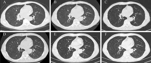 Figure 1 The images of CT scan of the patient. The patient received ten cycles of maintenance therapy with durvalumab between July 2021 and April 2022. (A) CT scan of the patient on March 10, 2021 showed massive shadow in the middle and lower lobes of the right lung near the hilar area (B) CT scan of the patient on September 25, 2021 showed significant reduction in primary tumor size (C) CT scan of the patient on February 28, 2022 showed reduction in primary tumor size (D) CT scan of the patient on August 17, 2022 showed no definite tumor recurrence or metastasis (E) CT scan of the patient on February 21, 2023 showed no definite tumor recurrence or metastasis. (F) CT scan of the patient on August 15, 2023 showed no definite tumor recurrence or metastasis.