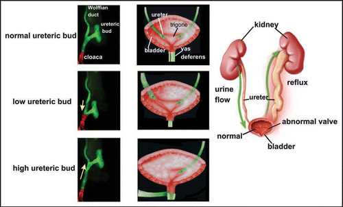 Figure 3 The Mackie Stephens hypothesis. Top: A ureteric bud emerging at the proper site on the Wolffian duct will join the trigone normally. Middle: A ureteric bud that forms too low on the Wolffian duct tends to join the bladder lateral or anterior to the normal insertion site causing reflux. Bottom: A ureteric bud forming too high on the Wolffian duct tends to remain attached to the sex ducts or joins the urogenital sinus posterior to its normal insertion site, causing obstruction. Green, Wolffian ducts and ureters; Red, cloacal endoderm and bladder trigone. Abbreviations: ub, ureteric bud; Wd, Wolffian duct.