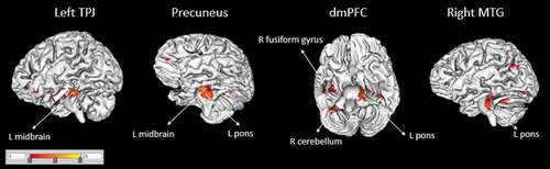 Figure 1. Functional connectivity of seed regions (in larger font, corrected for multiple comparisons) with other brain areas (smaller font) for the Child abuse > Unaffected comparisons contrast. There were no areas for which Unaffected comparisons > Child abuse. TPJ = temporo-parietal junction; dmPFC = dorsomedial prefrontal cortex; MTG = middle temporal gyrus; R, right; L, left.