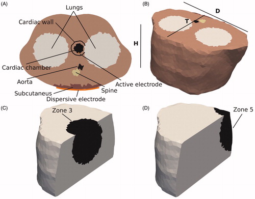 Figure 4. (A) Cross section of the fourth 3D model geometry. (B) The structures were immersed in a thorax with realistic boundaries. The dimensions of the model are: T = 30 cm, D = 42 cm, and H = 18 cm. (C) Zone 3 with radius of 8 cm (Zones 1 and 2 were concentric). (D) Zone 5 covers the dispersive electrode.