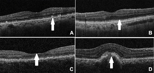 Figure 1 OCT images of some AMD cases: (A) Early AMD (white arrow: drusen, (B) Intermediate AMD (white arrow: pigmentary changes, (C) Late AMD with geographic atrophy (white arrow: macular atrophy), (D) Late AMD with CNV (white arrow: CNV).
