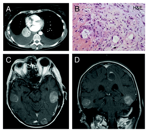 Figure 4. Radiographic findings in patient 3. (A) an initial CT-scan of the chest showed a large right hilar tumor with bilateral pleural effusions. (B) A biopsy of her right hilar tumor showed moderately-differentiaed adenocarcinoma. (C) Sn axial image and (D), a frontal/coronal image from a brain MRI showing development of multiple large metastases.