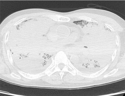 Figure 3 Computed tomography scans obtained at autopsy show that the lungs were completely infiltrated by effusion.