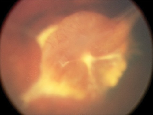 Figure 1 Example of severe dysgenesis with unregressed stalk tissue and primitive retinal development.