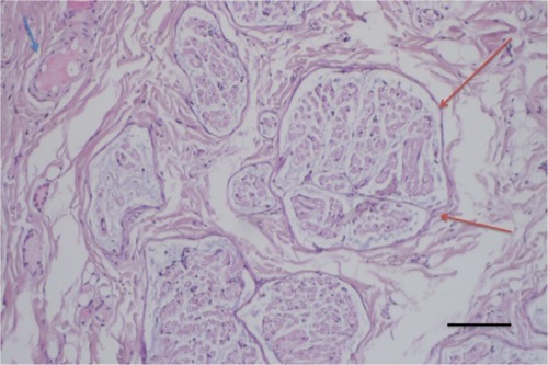 Figure 2 Some coagulation damage (blue arrow) of the surrounding fat and collagenous tissue, which in one instance was within a distance of ~100 μm of the nerve fascicle, without causing damage to the nerve fascicle (red arrows).