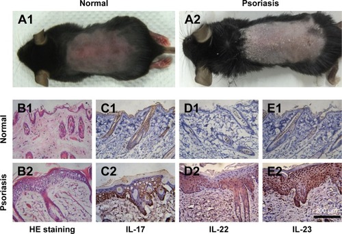 Figure 3 Topical application of imiquimod-induced psoriatic like change on the dorsal skin of mice.Notes: At day 7, photographs were taken from the mice (A1, A2) and H&E staining (B1, B2, ×250 magnification) was performed to observe the differences of between the normal skin (A1 and B1) and IMQ-psoriatic skin (A2 and B2). Immunohistochemistry of IL-17 (C), IL-22 (D), and IL-23 (E) were performed on both normal (C1–E1) and imiquimod-psoriatic skin (C2–E2).