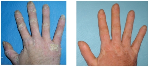 Figure 1 Complete clinical response of plaque type psoriasis with nail involvement after 3 infusions of infliximab.