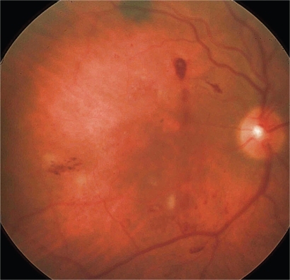 Figure 4 Retinal hemorrhage and leak into the vitreous from a single laser spot in the superior aspect of the retina where grid laser was performed.
