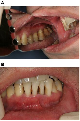 Figure 3 (A) Upper right quadrant after antibiotic therapy. (B) Frontal lower teeth after antibiotic therapy.