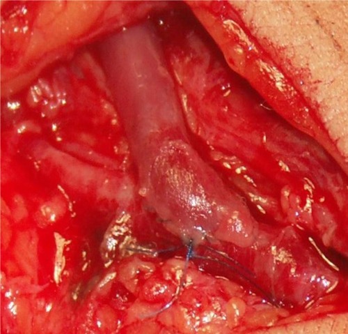 Figure 1 Native radio-cephalic arteriovenous fistula for hemodialysis, with latero-terminal anastomosis.