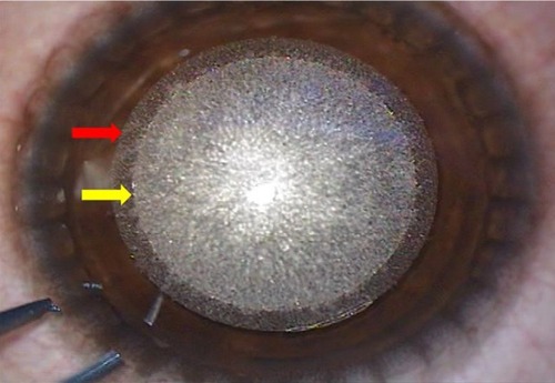 Figure 2 Two concentric rings visible after femtosecond laser application, with the outer ring signifying the cap cut (red arrow) and the inner ring signifying the lenticule cut (yellow arrow).