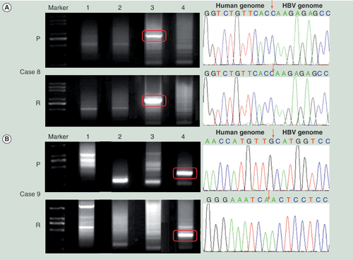 Figure 2.  Representative results of the HBV DNA integration patterns in the host cellular genome of the primary and recurrent tumors. (A) The HBV DNA integration in Case 8. (B) The HBV DNA integration in Case 9. Left panel shows the Alu-PCR results detected by agarose gel electrophoresis separation. Lanes 1–4 represent different PCR results using different Alu-PCR primers. Lane 1: HBV X gene primer as forward and Alu (+) primer as reversed; Lane 2: HBV preC/C gene primer as forward and Alu (+) primer as reversed; Lane 3: HBV X gene primer as forward and Alu (−) primer as reversed; Lane 4: HBV preC/C gene primer as forward and Alu (−) primer as reversed. The right panel shows the sequencing results of the circled bands in the left panel. The arrows indicates the location of HBV–host genome junctions.P: Primary hepatocellular carcinoma tumor; R: Recurrent hepatocellular carcinoma tumor.