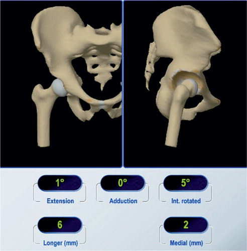 Figure 3. Intraoperative leg length and offset measurements obtained with the leg situation algorithm using an imageless navigation system.