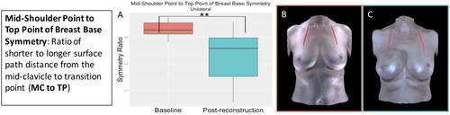 Figure 10. The mid-shoulder point to top point of breast base symmetry significantly decreased (became more asymmetrical) for the participants who underwent unilateral implant-based reconstruction (p = 0.002). (A) Boxplot of symmetry at baseline and post-reconstruction (median and interquartile range). (B) The mid-shoulder point to top point of breast base measurement on an exemplar patient. (C) The mid-shoulder point to top point of breast base measurement on the same patient post-reconstruction.