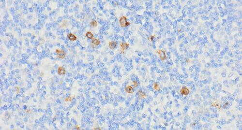 Figure 5 Immunohistochemical staining CD30 (magnification 400x). The stains included anti-CD20, CD3, CD30, CD15, PAX5, MUM-1, Ki-67.