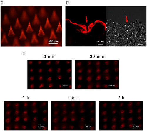 Figure 3. Skin insertion of SRB-loaded microneedles in vitro. (a) Fluorescence microscopy of SRB-loaded MN. (b) Fluorescence and bright-field microscopy of a longitudinal section of skin tissue of rats 2 min after SRB-loaded MNs pierce the skin. (c) Diffusion of SRB after skin insertion at 0, 30, 60, 90, and 120 min. Abbreviations: SRB, sulforhodamine B; MN, microneedle.