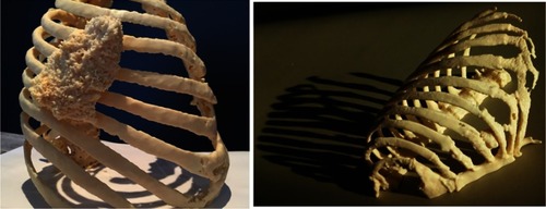 Figure 3 Two chest tumor models printed using FDM technology.