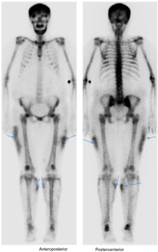 Figure 5 Whole-body bone scan.