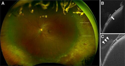 Figure 3 (A) A multimodal imaging of a 26-year-old female with a rhegmatogenous retinal detachment treated with an encircling buckling in the left eye. (A) An ultra-widefield fundus photograph. A protrusion of the encircling buckle is observed. Retinal holes (yellow arrows) are observed on the protrusion of the buckle. (B) An ultra-widefield swept-source optical coherence tomography (UWF-SSOCT) image of the yellow line on (A). The edge of the retinal hole is slightly detached (white arrow). (C) An UWF-SSOCT image of the yellow-dotted line on (A). A vitreoretinal traction (white arrowheads) is observed and a remnant subretinal fluid (white asterisk) is also observed. A gentle curve due to the buckle is recognized on (B and C).