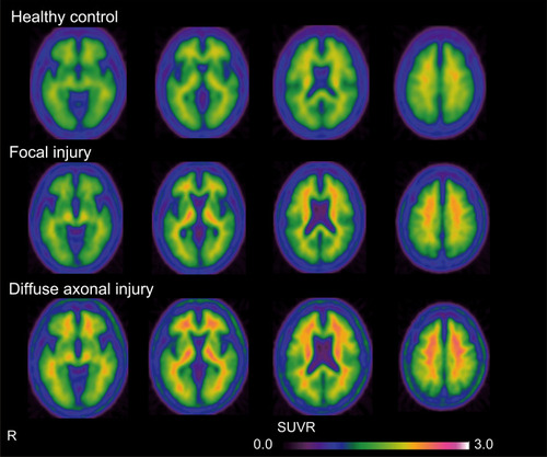 Figure 1 Mean axial PET images of 18F-FPYBF-2 PET in healthy control (n = 30) and patients with focal injury (n = 12) or DAI (n = 8). In the healthy controls, 18F-FPYBF-2 uptake was mainly observed in cerebral white matter. In the DAI group, 18F-FPYBF-2 uptake was observed in cerebral gray matter as well as white matter.