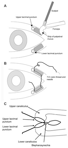 Figure 1 Schematic view of medial blepharosynechioplasty (MBSP) in the right eye. (A) Excision of two strips of palpebral conjunctiva, each measuring 2 × 3 × 0.5 mm (width × length × thickness), from the medial side of the upper and lower puncta to facilitate formation of a synechia. (B) The incised eyelids were sewn together in the immediate vicinity of the puncta with 7-0 nylon in conjunction with insertion of a lacrimal probe into the canaliculus to prevent damage to it. (C) Enlarged view near the lacrimal puncta after MBSP.