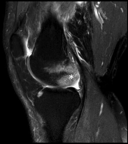 Figure 3 MRI: femoral condyle ischemia.