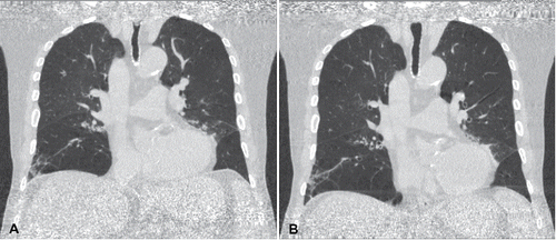 Figure 1. Coronal images at maximum expiratory level (A, phase 20%) and maximum inspiratory level (B, phase 60%) at the identical anatomical position showing the diagnostic quality of the data.