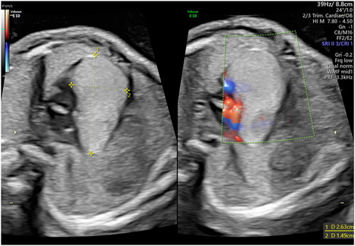 Figure 1. Echocardiographic appearance of the mass at 23 weeks of gestational age.