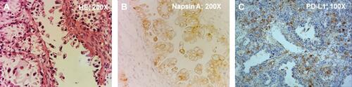 Figure 1 Hematoxylin-Eosin (HE) staining and immunohistochemistry of the OCCC. (A) HE staining determined it was an ovarian cancer; Magnification: 200X. (B) Positive of Napsin A determined it was an OCCC. Magnification: 200X. (C) The patient’s tumor had positive expression of PD-L1 (tumor proportion score of 10%). Magnification: 100X.