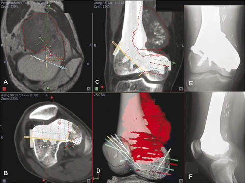 Figure 9. Preoperative screen images of surgical navigation planning on the navigation monitor. (A) shows the extent of the tumor (red dotted line) in the sagittal-view CT-MR image fusion. As back-conversion of the prosthesis from CAD to DICOM format was possible, the CAD prosthesis could be integrated into the navigation planning by CT-CT/prosthesis image fusion. Axial (B) and coronal (C) images illustrate the appearance of the prosthesis (in white) in the planning. This integration greatly facilitated the precise definition of multi-planar osteotomies at the distal femur. (D) shows the reconstructed 3D bone tumor model with the planes of resection defined by virtual pedicle screws. Use of CAD/CAM surgical planning and intraoperative navigational guidance enabled accurate tumor resection and precise fitting of the complex CAD prosthesis, as confirmed by postoperative plain radiographs (E and F).