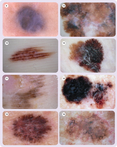 Figure 13. Regression structures (blue areas are melanosis, white areas are fibrosis)
