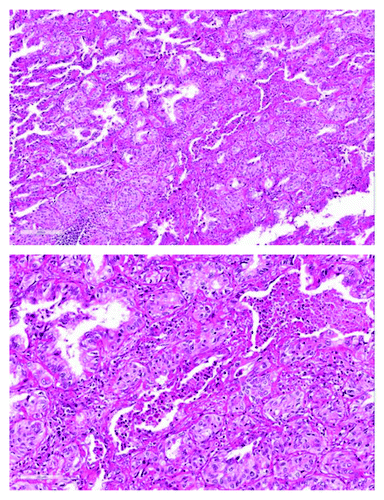 Figure 1. H&E (hematoxylin and eosin) staining of a lung resection specimen shows predominantly adenocarcinoma histology with areas of squamous differentiation.