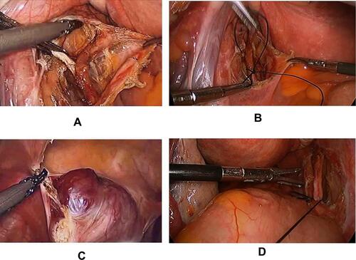 Figure 1 Laparoscopic TIIAB. (A) Left internal iliac artery anatomy. (B) Internal iliac artery slipknot (No. 7 silk) ligation. (C) CSP cite. (D) Slipknot unlocking after pregnancy tissue removal.