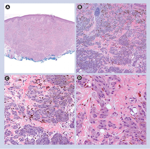 Figure 6. Atypical Spitz tumor.(A) Dermal-based lesion with sheet-like growth pattern and incomplete maturation (40×). (B & C) Nests do not become smaller in deeper dermis (100× and 200×, respectively). (D) Melanocytes are epithelioid with nuclear pleomorphism (400×).