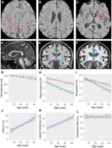 Figure 2 Structural changes in the brain. (A–C) The SWI scan acquired at age 76 shows cerebral microbleeds in the white matter and all four lobes (circled in (A) and arrows in (B)) as well as symmetric iron depositions in the caudate nuclei (arrowhead in (C)) and putamen (arrows in (C)). (D) The midsagittal slice of his T1 scan acquired at age 84 shows the relatively reserved the corpus callosum, brainstem, and cerebellum. (E and F) Segmentation of the corpus callosum (cyan), lateral ventricles (steel blue), third ventricle (brown), midbrain (blue), left amygdala (lime green), right amygdala (purple), left hippocampus (pink), and right hippocampus (salmon) on MRI scans acquired at age 76 (E) and age 84 (F). (G-L) Volumetric changes in left (red) and right (turquoise) hemisphere (G), left and right hippocampus (H), left and right amygdala (I), white matter hyperintensities (WMHs) (J), lateral ventricles (K), and cerebellar white matter (WM) (L).