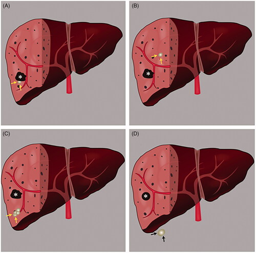 Figure 2. The graphical representations of four types of tumor recurrence after MWA. (A) LTP was defined according to imaging results of abnormal nodular, disseminated, and/or unusual patterns of peripheral enhancement around the ablation site in patients treated with MWA; (B) IDR was described as the appearance of an abnormal nodular, disseminated, or unusual patterns of peripheral enhancement of intrahepatic lesions, which were further away from the ablation zone after MWA treatment; (C) AIR was described as the generation of multiple nodular (≥3) distant from the edge of the ablation zone and the infiltrative recurrence in the treated liver segment that showed enhancement in hepatic arterial phase images and washout on portal or delayed venous phase images at follow-up. The AIR was confined to the initial manifestation of tumor recurrence in patients who were previously considered to have a disease-free status at least 6 months after initial MWA to avoid confusion with IDR [Citation18]; (D) EDR was defined as distant metastasis in the extrahepatic, which has the appearance of an abnormal nodular, disseminated, or unusual patterns of peripheral enhancement of intrahepatic lesions.