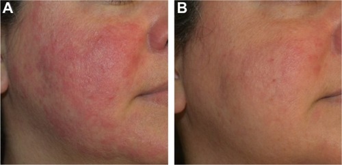 Figure 6 Before (A) and after (B) oxymetazoline (Afrin®) combined with a topical moisturizing cream (CeraVe®) applied twice daily. Significant improvement in facial erythema was seen after only one day of application.