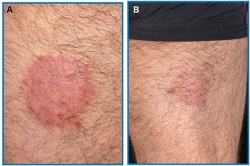 Figure 4 (A) Classic erythematosquamous plaque on the posterior thigh in a 35-year-old male before treatment with Cal/BD aerosol foam. (B) Psoriatic lesion after 4 weeks’ treatment with Cal/BD aerosol foam.