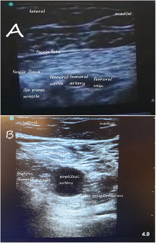 Figure 1. Sonographic view of the femoral and gluteal regions (A) femoral nerve (B) sciatic nerve.