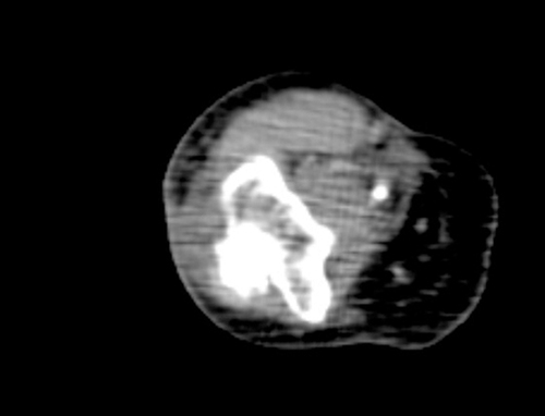 Figure 1 Spiral enhanced computer scan of right arm showed mild edema.