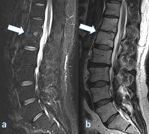 Figure 2 Magnetic resonance imaging of the lumbar spine 18 months after the end of antimicrobial treatment. (a) Sagittal STIR and (b) sagittal T2 images. Note the resolution of the bone edema in the vertebral endplate and the absence of intervertebral or paravertebral fluid (white arrows). Signs are compatible with spondylodiscitis cure.
