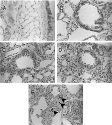 FIG. 1 Histological changes in GaAs-exposed lungs. Lung sections were stained with hematoxylin and eosin 5 days after intratracheal instillation of GaAs at (A and B) 12.5 mg/kg, (C) 50 mg/kg, and (D and E) 200 mg/kg. GaAs crystals were present in the lungs (arrowheads). (×400).